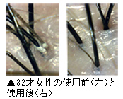 32才女性使用前・使用後の写真