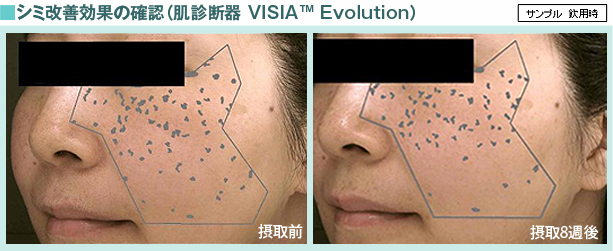 シミ改善効果の確認(肌診断器 VISIA Evolution)
