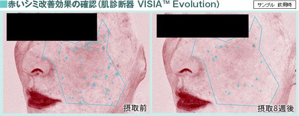 赤いシミ改善効果の確認(肌診断器 VISIA Evolution)