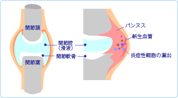 変形性膝関節症および関節リウマチのメカニズム