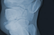 ロコモティブシンドロームひざ関節