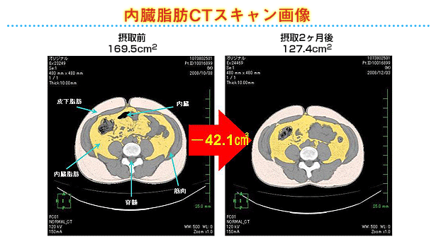 パロアッスルの脂肪燃焼効果　2か月摂取のヒト試験の結果（内臓脂肪CTスキャン画像）