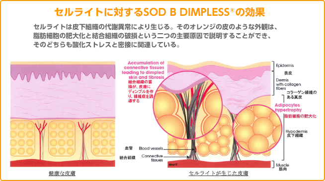 ストレスに伴う幾つかの症状を軽減するセルライトに対するSOD B<sup>®</sup>の効果